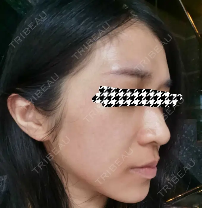 ピコレーザートーニング（美白・肝斑） 日比谷セントラルクリニック DAY 0 メイン用