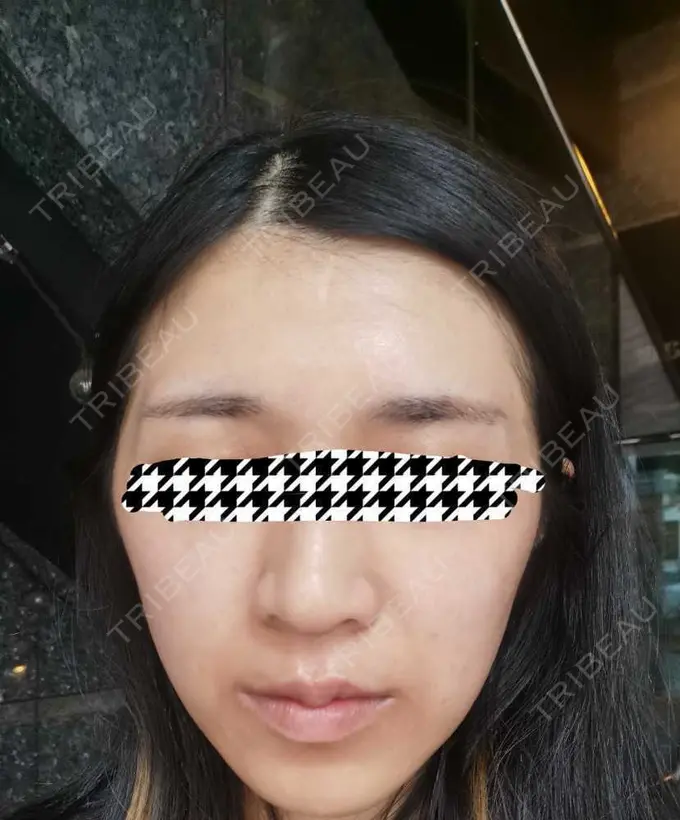 ピコレーザートーニング（美白・肝斑） 日比谷セントラルクリニック AFTER メイン用