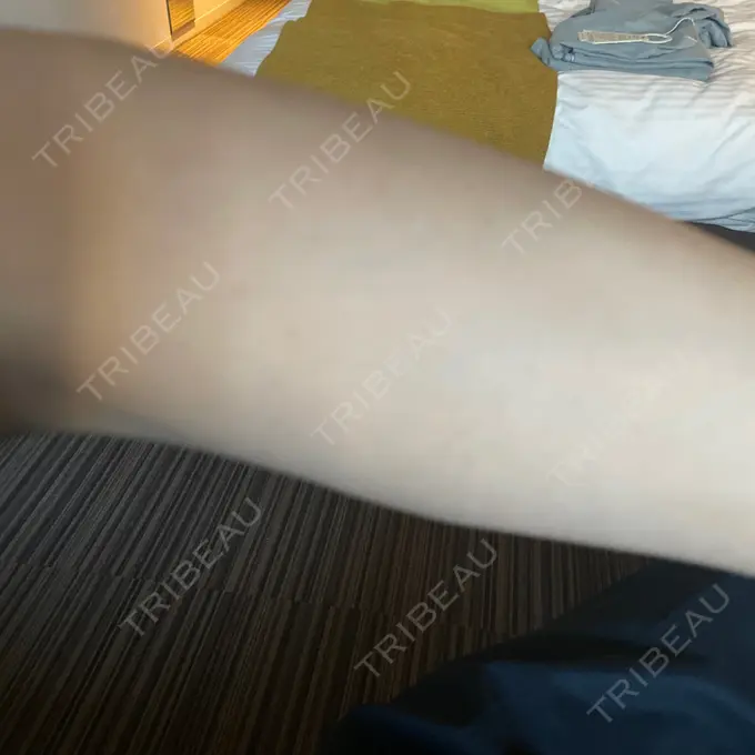 医療脱毛（腕） / 医療脱毛（お腹） / 医療脱毛（胸） 表参道メディカルクリニック 新宿院 DAY 1 メイン用