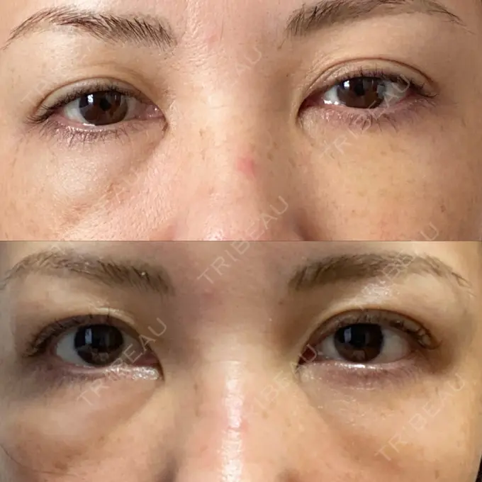 クマ治療 / 下まぶたたるみ取り / ヒアルロン酸注入（目の下） / ボトックス（目尻） TCB東京中央美容外科 神戸院 DAY 9 メイン用