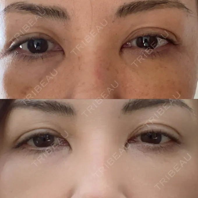 クマ治療 / 下まぶたたるみ取り / ヒアルロン酸注入（目の下） / ボトックス（目尻） TCB東京中央美容外科 神戸院 DAY 8 メイン用