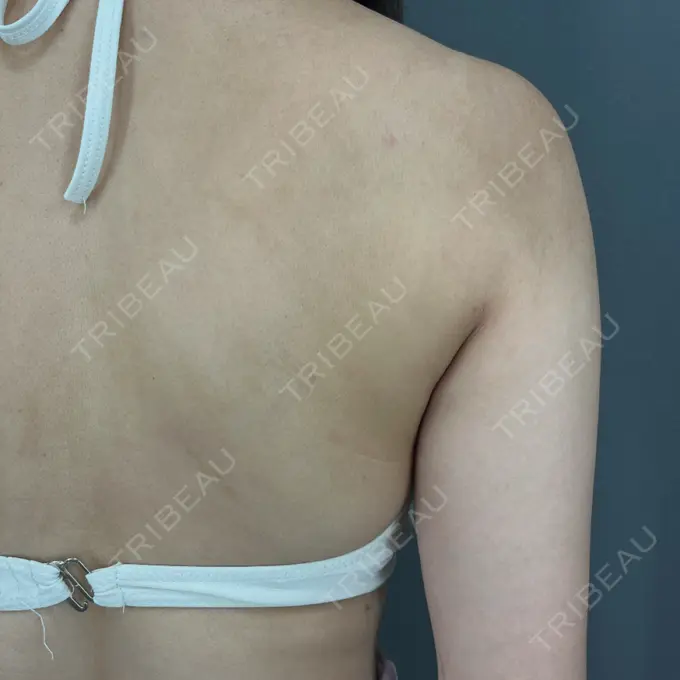 脂肪吸引（背中） ziz CLINIC DAY 36 メイン用