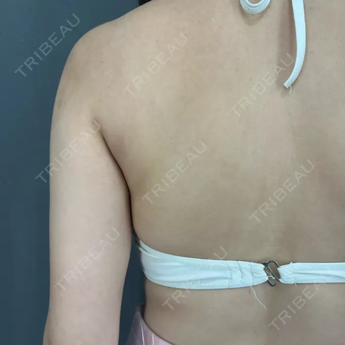 脂肪吸引（背中） ziz CLINIC DAY 36 メイン用