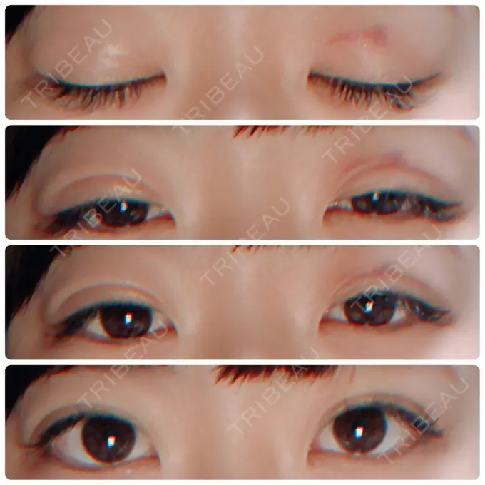 二重埋没 湘南美容クリニック 長野院 DAY 9 メイン用