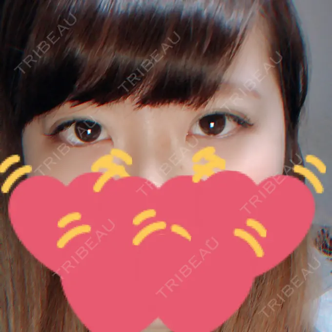 二重埋没 湘南美容クリニック 長野院 DAY 9 メイン用