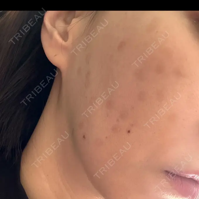 ピコレーザートーニング（美白・肝斑） G MEDICAL ART クリニック 新宿院 DAY 100 メイン用