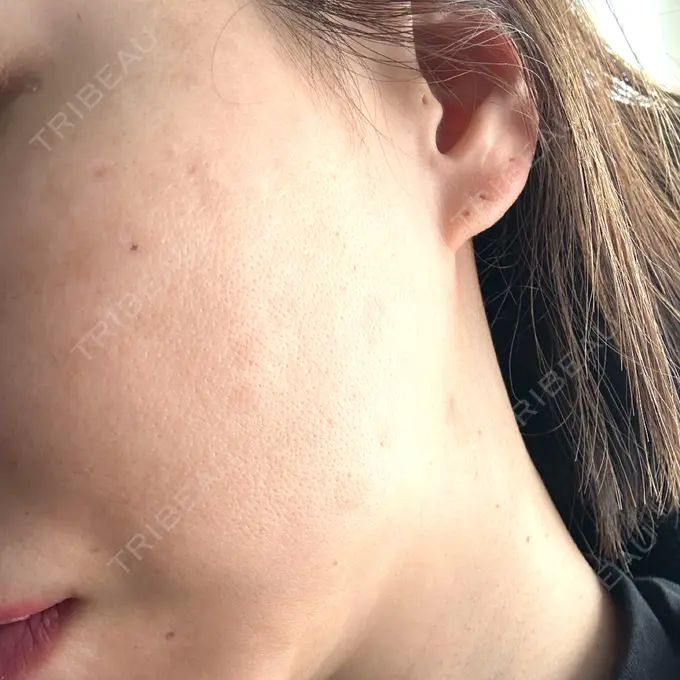 ピコレーザートーニング（美白・肝斑） G MEDICAL ART クリニック 新宿院 DAY 100 メイン用