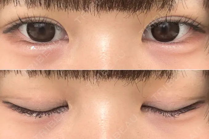 二重埋没 / 上まぶたの脂肪取り THE FIRST CLINIC 多摩センター院 AFTER メイン用