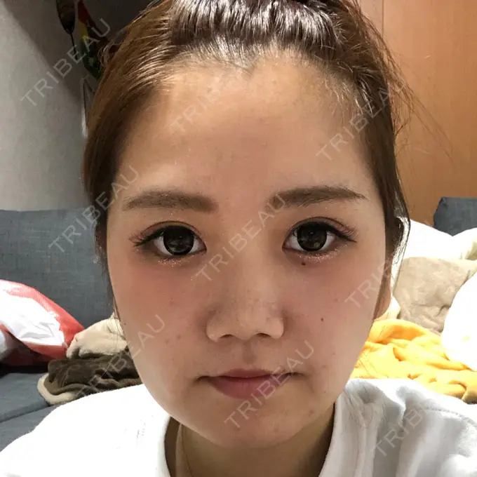 骨切り（あご） / 脂肪吸引（顔） 東京美容外科 赤坂院 DAY 17 メイン用