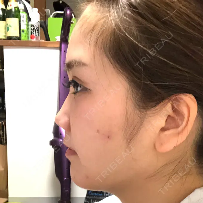 骨切り（あご） / 脂肪吸引（顔） 東京美容外科 赤坂院 DAY 17 メイン用