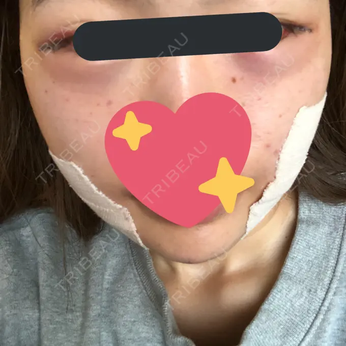 バッカルファット除去 / 脂肪吸引（顔） / 目尻切開 / 水光注射（ハリ・美肌） / ヒアルロン酸注入（あご） / ボトックス（エラ・小顔） / ボトックス（口角） / 白玉点滴・注射 / その他（肌） エートップ美容整形外科 DAY 1 メイン用