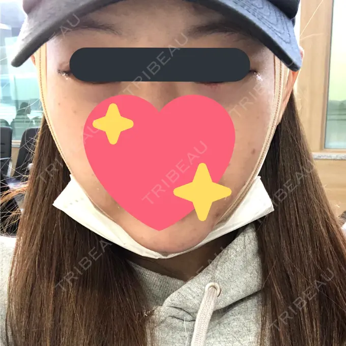 バッカルファット除去 / 脂肪吸引（顔） / 目尻切開 / 水光注射（ハリ・美肌） / ヒアルロン酸注入（あご） / ボトックス（エラ・小顔） / ボトックス（口角） / 白玉点滴・注射 / その他（肌） エートップ美容整形外科 DAY 1 メイン用