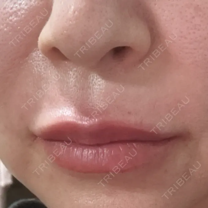 ヒアルロン酸注入（唇） / その他（輪郭） Code Beauty Clinic 名古屋院 DAY 1 メイン用