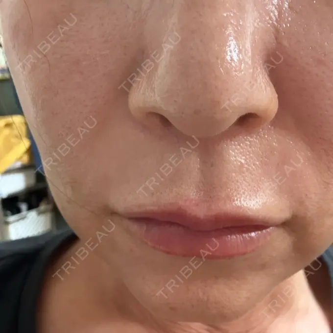 ヒアルロン酸注入（唇） / その他（輪郭） Code Beauty Clinic 名古屋院 DAY 2 メイン用