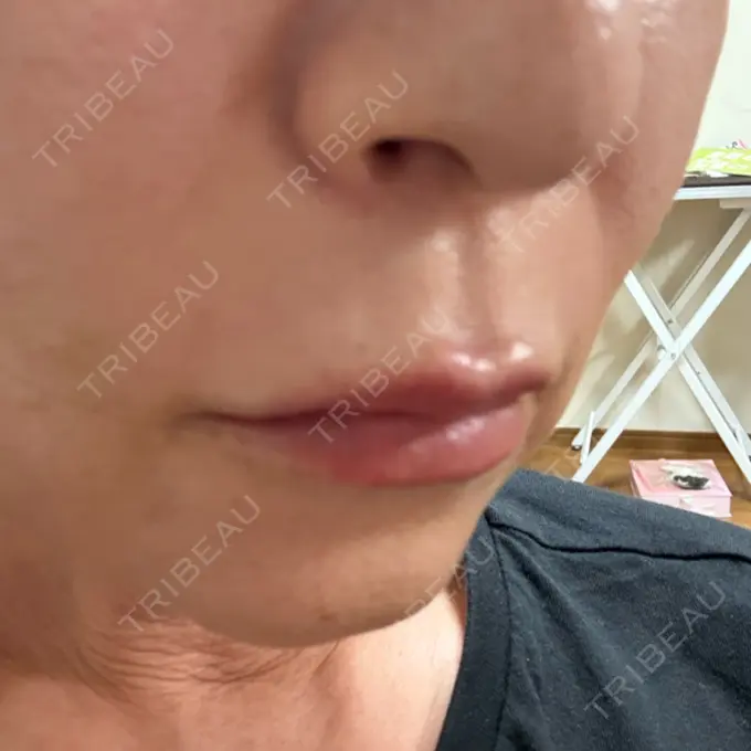 ヒアルロン酸注入（唇） / その他（輪郭） Code Beauty Clinic 名古屋院 AFTER メイン用