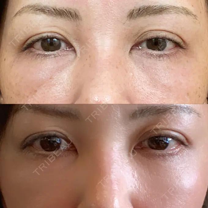 クマ治療 / 下まぶたたるみ取り / ヒアルロン酸注入（目の下） / ボトックス（目尻） TCB東京中央美容外科 神戸院 DAY 11 メイン用