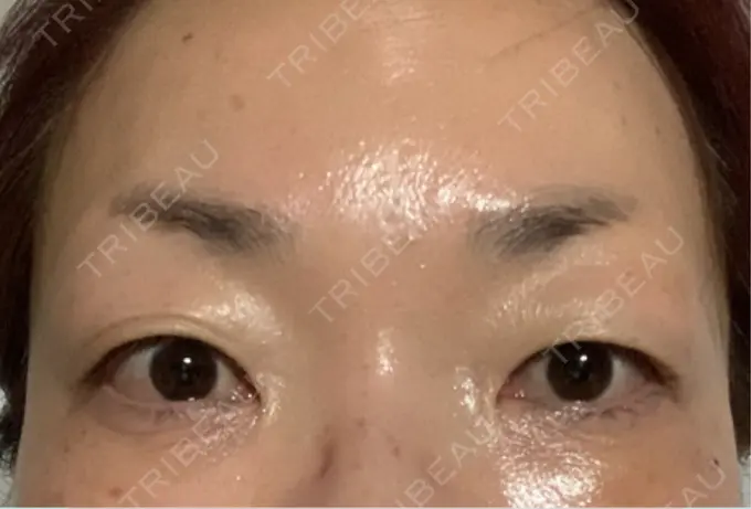 ボトックス（眉間） / ボトックス（目尻） / ボトックス（額） / その他（目元） TCB東京中央美容外科 名古屋栄院 DAY 7 メイン用