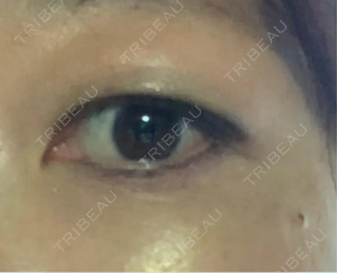 ボトックス（眉間） / ボトックス（目尻） / ボトックス（額） / その他（目元） TCB東京中央美容外科 名古屋栄院 DAY 8 メイン用