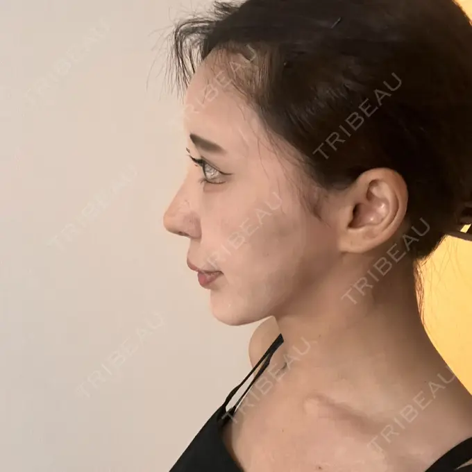 隆鼻術 / 糸リフト / 軟骨移植 / 脂肪注入（肌） / プロテーゼ除去 / 鼻修正 / 脂肪注入（額） / 脂肪注入（目の下） / その他（肌） id（アイディ）美容外科 DAY 21 メイン用