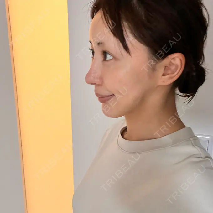 隆鼻術 / 糸リフト / 軟骨移植 / 脂肪注入（肌） / プロテーゼ除去 / 鼻修正 / 脂肪注入（額） / 脂肪注入（目の下） / その他（肌） id（アイディ）美容外科 DAY 170 メイン用