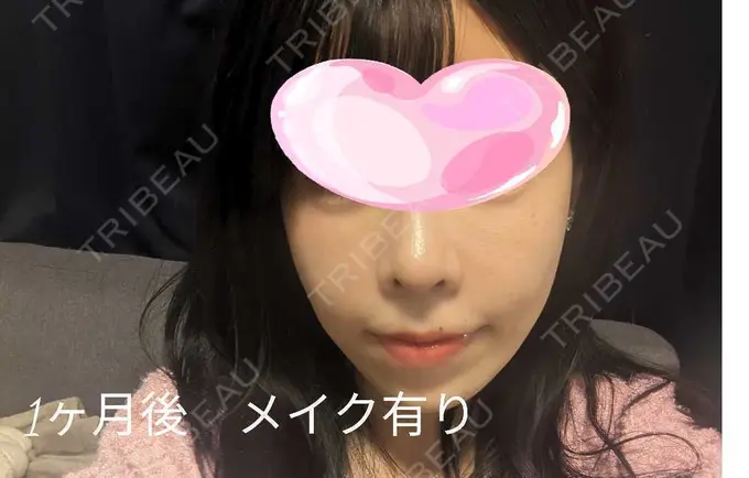 プロテーゼ除去 / 鼻翼基部形成（貴族手術） / 鼻尖形成（非切開） / 鼻中隔延長（非切開） ジョウクリニック 大阪院 DAY 14 メイン用