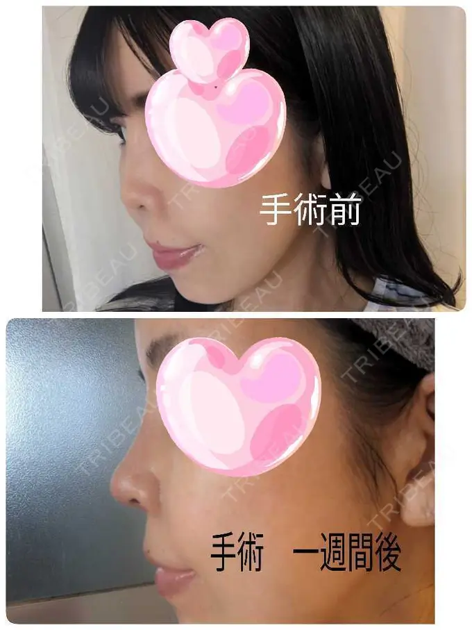 プロテーゼ除去 / 鼻翼基部形成（貴族手術） / 鼻尖形成（非切開） / 鼻中隔延長（非切開） ジョウクリニック 大阪院 AFTER メイン用