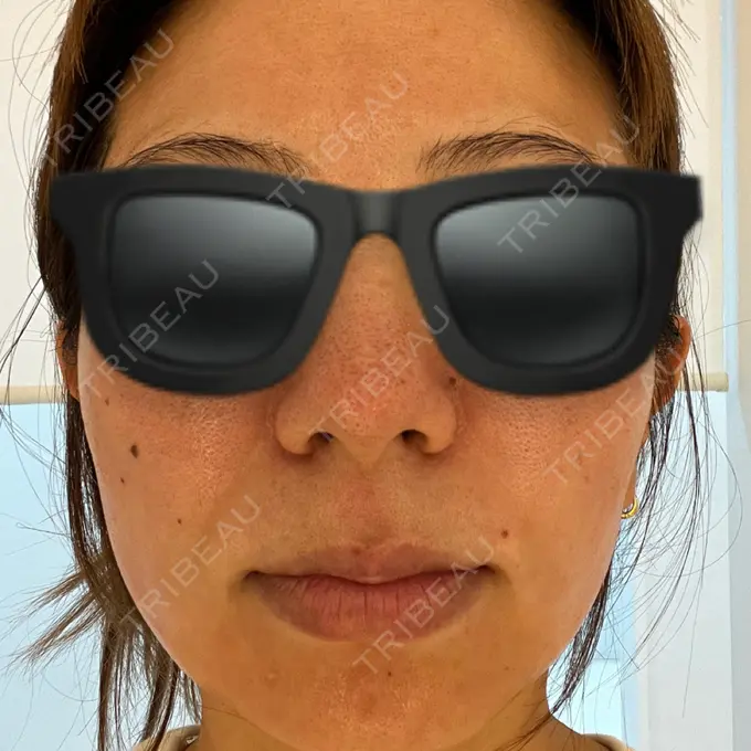 ピコレーザートーニング（美白・肝斑） / フラクショナルレーザー（毛穴・ニキビ跡） G MEDICAL ART クリニック 新宿院 DAY 0 メイン用