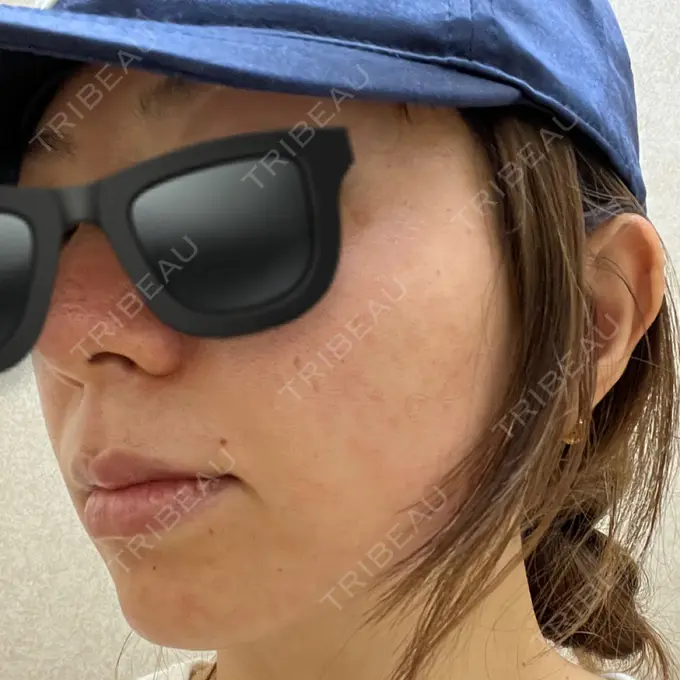 ピコレーザートーニング（美白・肝斑） / フラクショナルレーザー（毛穴・ニキビ跡） G MEDICAL ART クリニック 新宿院 DAY 0 メイン用