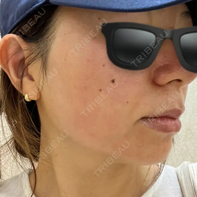 ピコレーザートーニング（美白・肝斑） / フラクショナルレーザー（毛穴・ニキビ跡） G MEDICAL ART クリニック 新宿院 DAY 0 メイン用