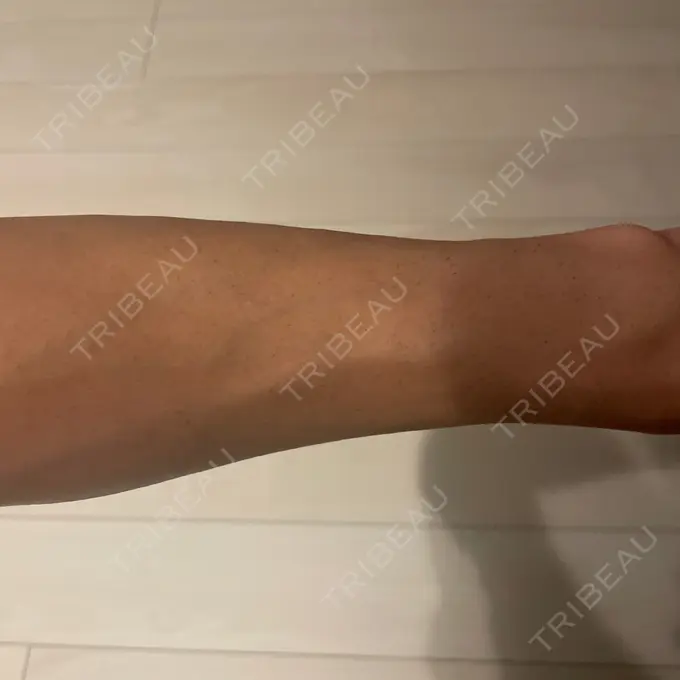 医療脱毛（腕） / 医療脱毛（お腹） / 医療脱毛（胸） 表参道メディカルクリニック 新宿院 DAY 6 メイン用