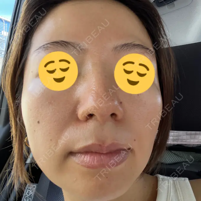 ピコレーザートーニング（美白・肝斑） / フラクショナルレーザー（毛穴・ニキビ跡） G MEDICAL ART クリニック 新宿院 AFTER メイン用