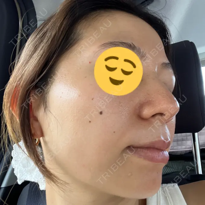 ピコレーザートーニング（美白・肝斑） / フラクショナルレーザー（毛穴・ニキビ跡） G MEDICAL ART クリニック 新宿院 DAY 1 メイン用