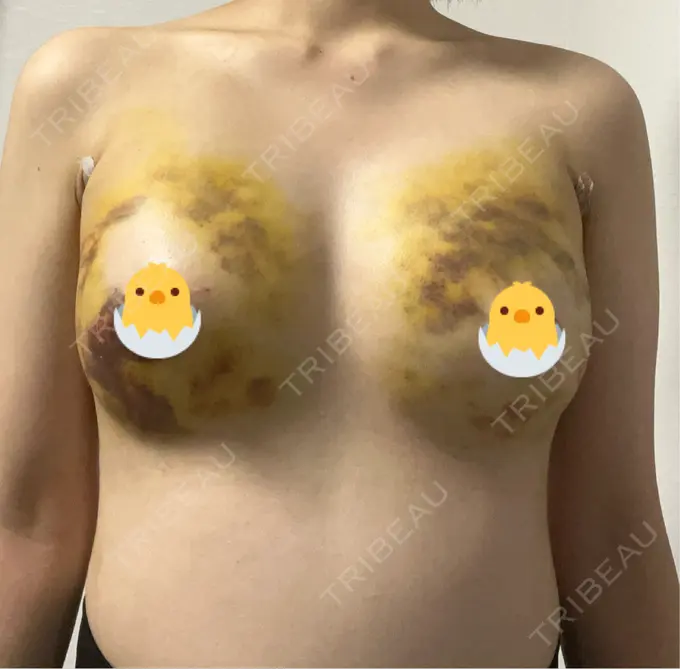 豊胸（脂肪注入） 湘南美容クリニック 新百合ヶ丘院 DAY 4 メイン用