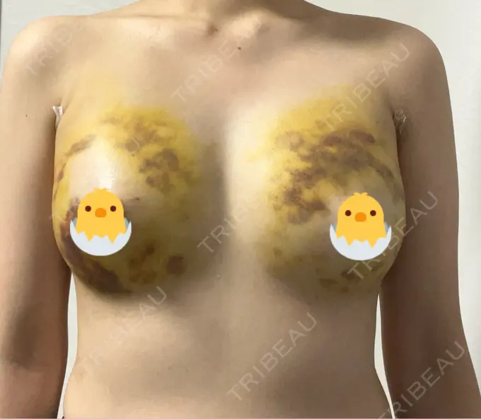 豊胸（脂肪注入） 湘南美容クリニック 新百合ヶ丘院 DAY 5 メイン用