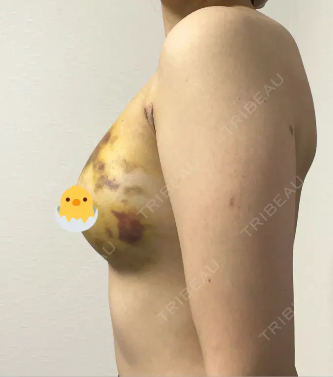 豊胸（脂肪注入） 湘南美容クリニック 新百合ヶ丘院 DAY 5 メイン用