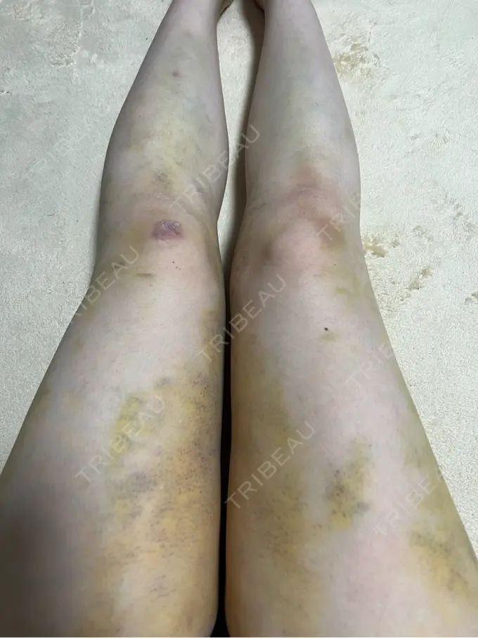 豊胸（脂肪注入） 湘南美容クリニック 新百合ヶ丘院 DAY 5 メイン用