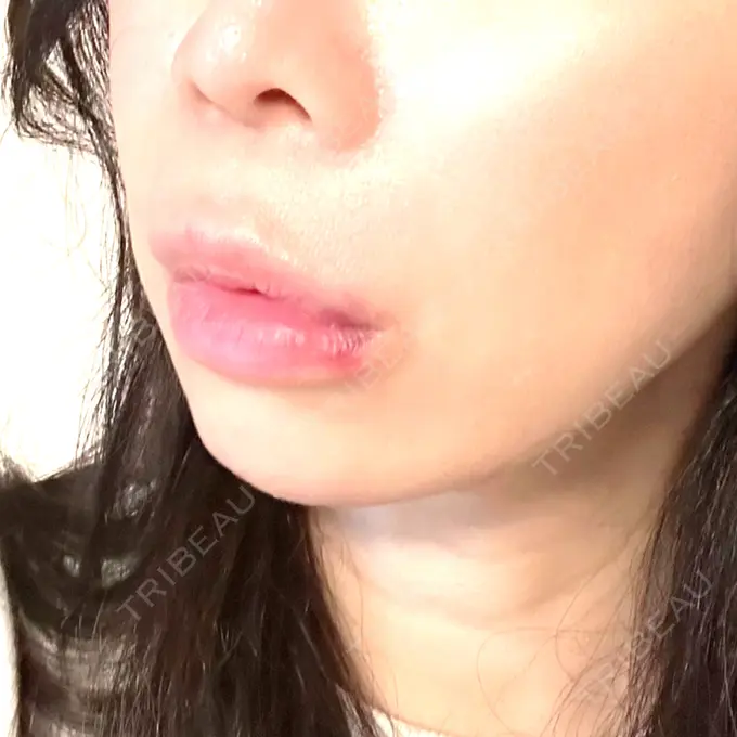 ヒアルロン酸注入（唇） / ボトックス（口角） / その他（鼻） ルラ美容クリニック 仙台院 / ルラスキンクリニック 仙台院 AFTER メイン用