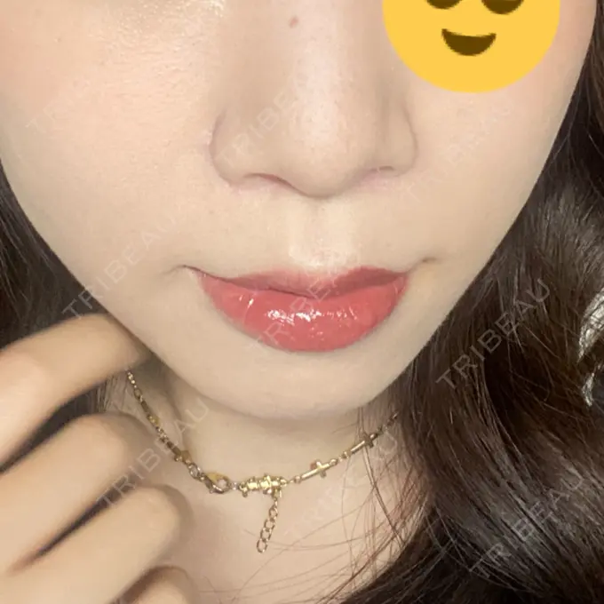 人中短縮 / 鼻翼挙上 / 鼻尖縮小 Otus Clinic 【オータスクリニック】 DAY 50 メイン用