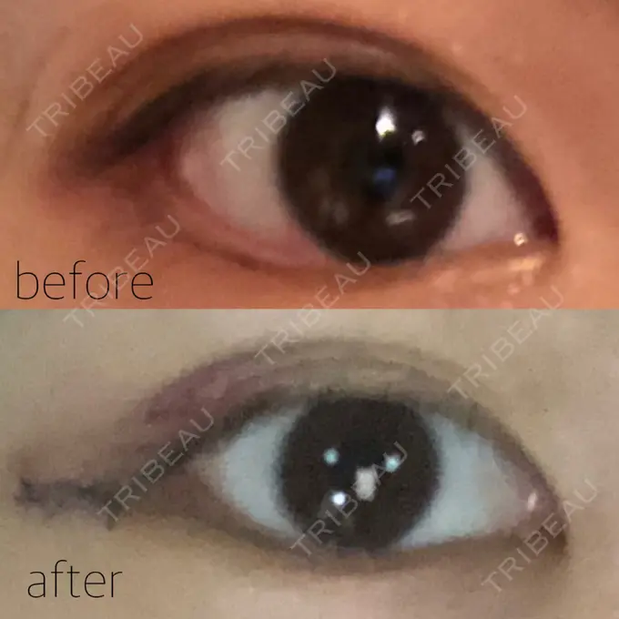 バッカルファット除去 / 脂肪吸引（顔） / 目尻切開 / 水光注射（ハリ・美肌） / ヒアルロン酸注入（あご） / ボトックス（エラ・小顔） / ボトックス（口角） / 白玉点滴・注射 / その他（肌） エートップ美容整形外科 DAY 2 メイン用