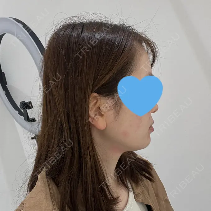 ハイフ（顔） Mavie Beauty Clinic （マヴィービューティークリニック） AFTER メイン用