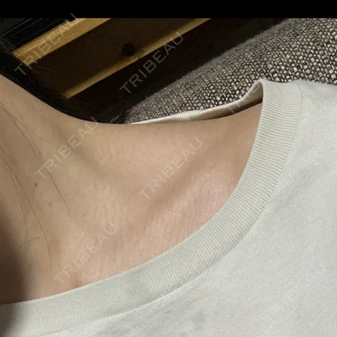 ボトックス（肩） DMTC CLINIC 渋谷院 AFTER メイン用