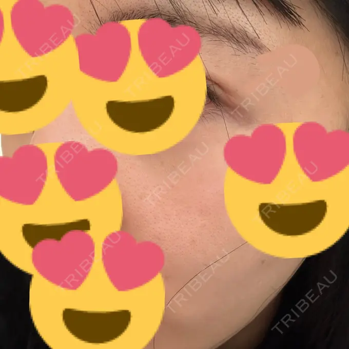 糸リフト / 脂肪吸引（顔） / 脂肪吸引（二の腕） / 上まぶたたるみ取り / 上まぶたの脂肪取り / ジョールファット除去 / 脂肪吸引（肩） / ボトックス（エラ・小顔） 湘南美容クリニック 秋葉原院 DAY 143 メイン用