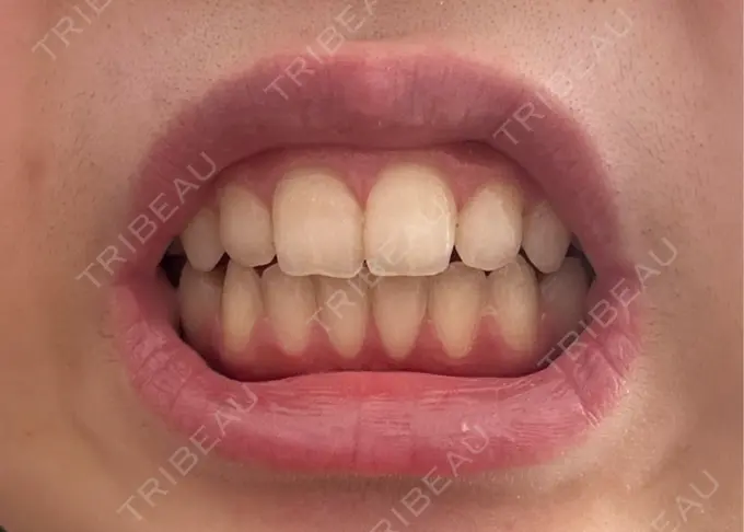 ホワイトニング LEAGRANT CLINIC 中目黒 DAY 5 メイン用