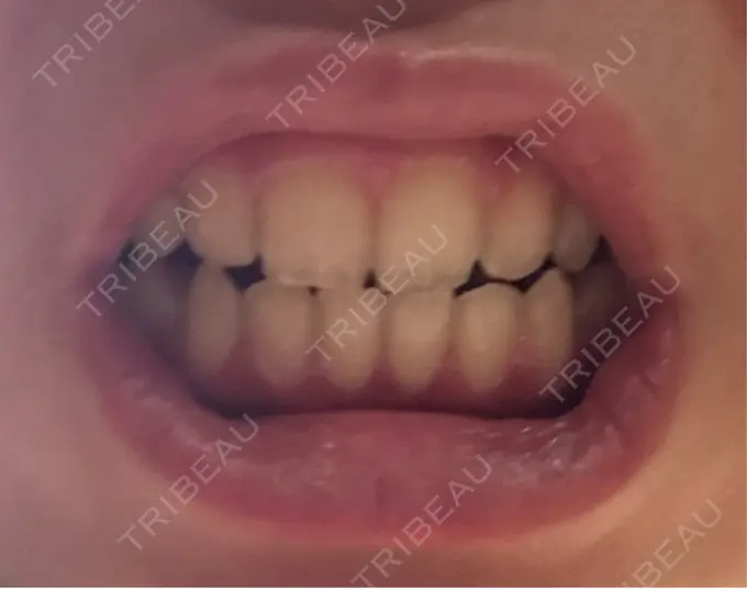 ホワイトニング LEAGRANT CLINIC 中目黒 DAY 4 メイン用