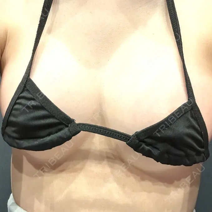 豊胸（シリコンバッグ） Code Beauty Clinic 名古屋院 AFTER メイン用