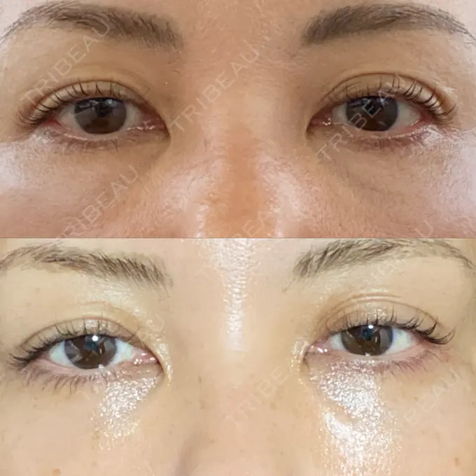 クマ治療 / 下まぶたたるみ取り / ヒアルロン酸注入（目の下） / ボトックス（目尻） TCB東京中央美容外科 神戸院 DAY 15 メイン用