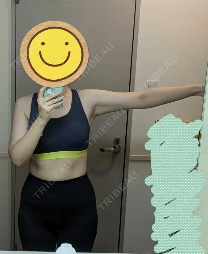 脂肪吸引（二の腕） / 脂肪吸引（肩） / その他 湘南美容クリニック 銀座院 DAY 177 メイン用