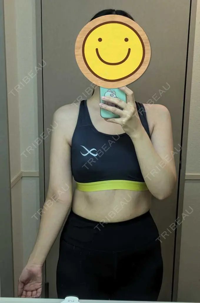 脂肪吸引（二の腕） / 脂肪吸引（肩） / その他 湘南美容クリニック 銀座院 AFTER メイン用