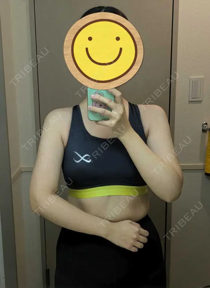 脂肪吸引（二の腕） / 脂肪吸引（肩） / その他 湘南美容クリニック 銀座院 DAY 177 メイン用