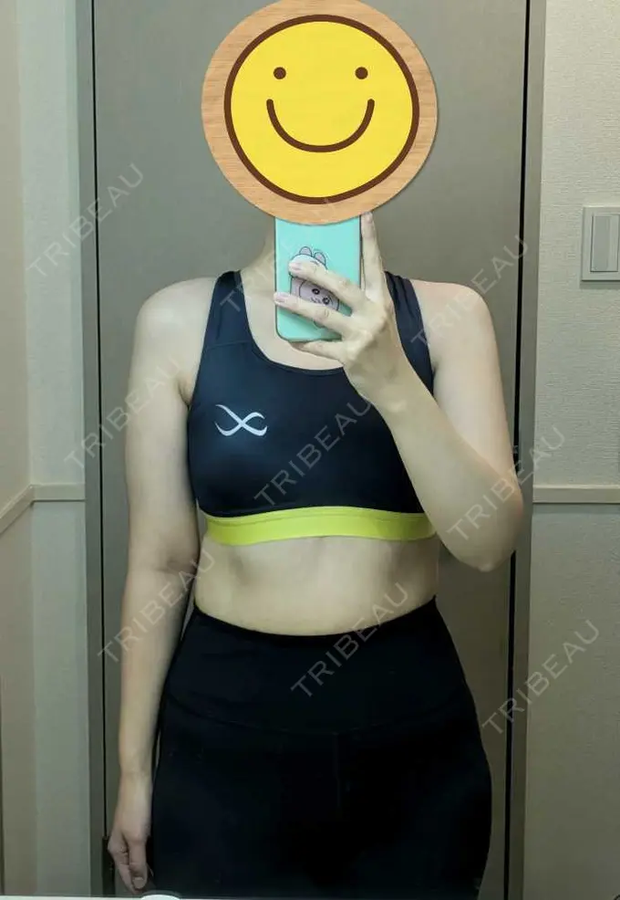 脂肪吸引（二の腕） / 脂肪吸引（肩） / その他 湘南美容クリニック 銀座院 DAY 177 メイン用